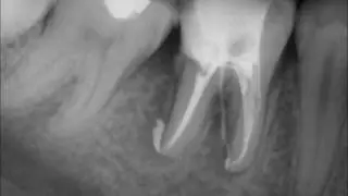 Calcium Hydroxide Extrusion