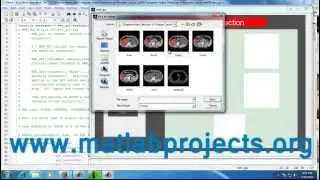 Prostrate Cancer Detection Image Processing  Matlab Projects