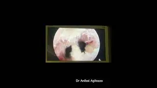 Hysteroscopic Metroplasty and Polipectomy with Bigatti Shaver