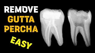 Gutta percha removal | Endodontic retreatment