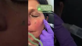 Everyone Can Use a Little Volume in Their Cheeks!