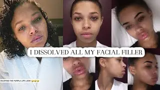 My Experience With Filler: Dissolving it All and Reclaiming My Natural Beauty