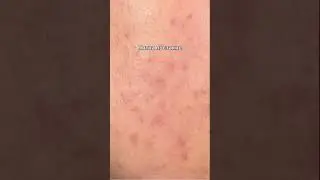 Что делать, если есть расширенные поры, чёрные точки и пятна постакне? 