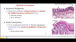 hypertrophy- metaplasia.