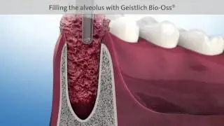 Ridge Bone Preservation Tooth Extraction