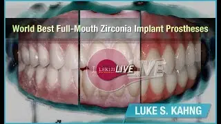 World Best Full-Mouth Zirconia Implant Prostheses
