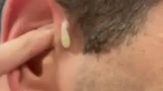 Top Three Pimple Pops of August 2023