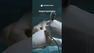 Operasi Menggunakan Tangan Robot Laparoskop