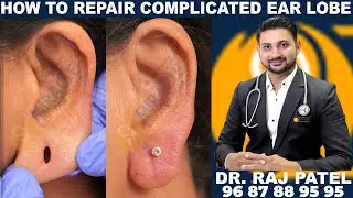कान का छेद बड़ा है तो घबराएं नहीं इस उपाय से करें छोटा | ear hole repair closing without surgery