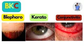 BKC: Blepharo-Kerato-Conjunctivitis. Dr Shaz Rehan.