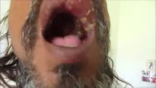 Herpes Zoster In Oral Cavity & Face