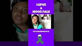 Lupus Nephritis and Moon Face  #lupuswarrior