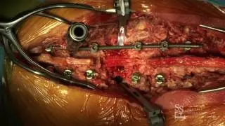 Thoracic Osteotomy - Christopher I. Shaffrey, MD (Live Demo)