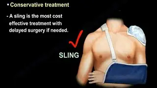 Clavicle Fractures, symptoms,  types, diagnosis and  treatment with  surgery and without surgery.