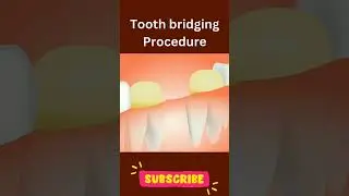 Tooth Bridging Procedure