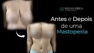 Tudo Que Você Precisa Saber Sobre o Mastopexia em L | Dr. Wilian Pires
