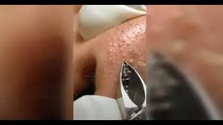 *EXTREMELY SATISFYING** Pimple, Blackhead, and Whitehead Removal | ASMR & MORE