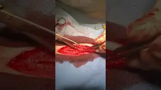 suturing the linea using simple interrupted pattern