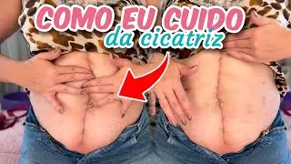 CUIDADOS E PRODUTO que uso para MELHORAR A CICATRIZ