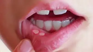 Milk kasalliklari va uni davolash (стоматит)
