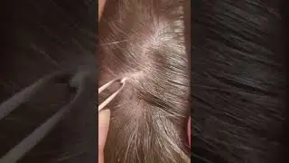 Ingrown Removal 