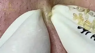 The Most Satisfying Blackhead Removal Videos on YouTube