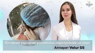 Лазерное удаление сосудистых образований (Velur S5)