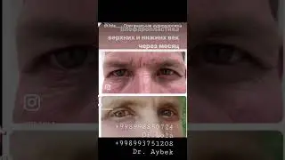 Блефаропластика верхних и нижних век броулифтинг филлеры губы плазмолифтинг+998998850724 dr. Lola