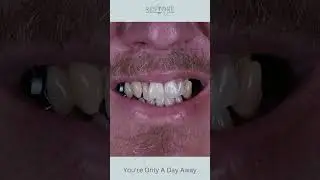 Bruce C. Smile Transformation with Restore in 24 all on 4 dental implants