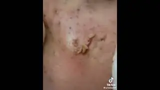 Выдавливание чёрных точек