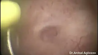 Adenomiosis