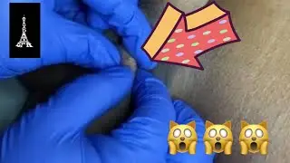 AWESOME EXTRACTION 🙌🙌🙌 Squeeeeezeeee