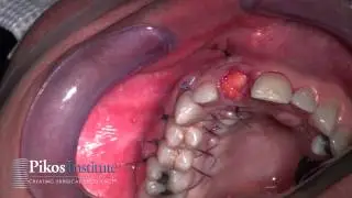 Pikos Implant Institute Soft Tissue Grafting Continuing Education Course