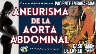ANEURISMA DE LA AORTA ABDOMINAL