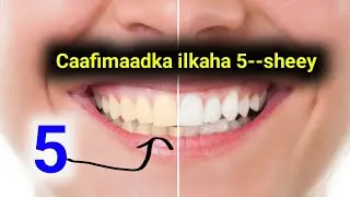 Caafimaadka-- ilkaha 5--taan sheey ma sameeysaa ??