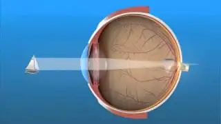 Visión de Lejos Hipermetropía _ Palomera Ópticos Mislata