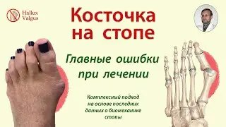 Ошибки лечения косточки на стопе