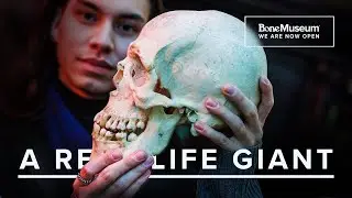 WE HAVE A GIANT? Exploring the Rare Condition of Gigantism | The Bone Museum