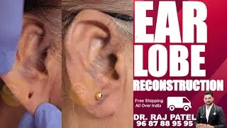 कान का छेद हमेशा के लिए छोटा करने का आसान तरीका / Ear Pasting Lotion / Ear Lobe / Hole Repair / Ear