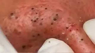 Blackheads!  Blackhead and Whiteheads on Face
