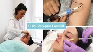 PRP Vampire Facelift | The Laser and Skin Clinic