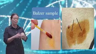 Infectious diseases of the skin:Fungal infection