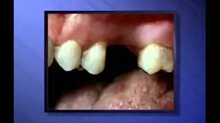 Partial Upper Denture - Miskin Ajax Dental