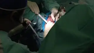 Имплантация искусственного сфинктера ZSI 375. Топузов Т.М. и Christophe Llorens. EndoUroCenter.
