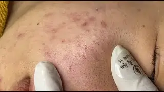 Inflammatory acne hematoma, hidden acne (Tham P.2) #HoangMySpa109