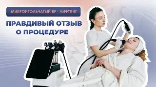 Микроигольчатый RF-лифтинг. ПРАВДИВЫЙ ОТЗЫВ О ПРОЦЕДУРЕ