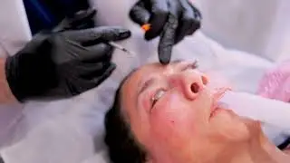 Undereye CO2 Laser - WATCH the skin contract
