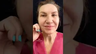 Глубокая смас подтяжка лица, 4 месяца после операции  #фейслифтинг