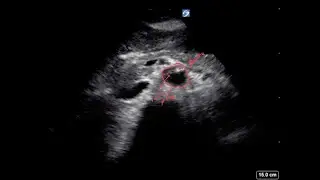 Positive EFAST exam with Ultrasound