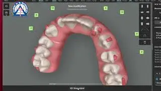 Monday Tip: How to move Peg Laterals with Clear Aligners!